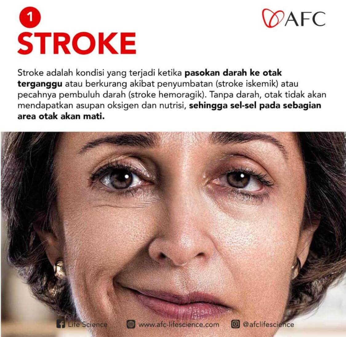 Gejala Dan Penyebab Terjadinya Stroke