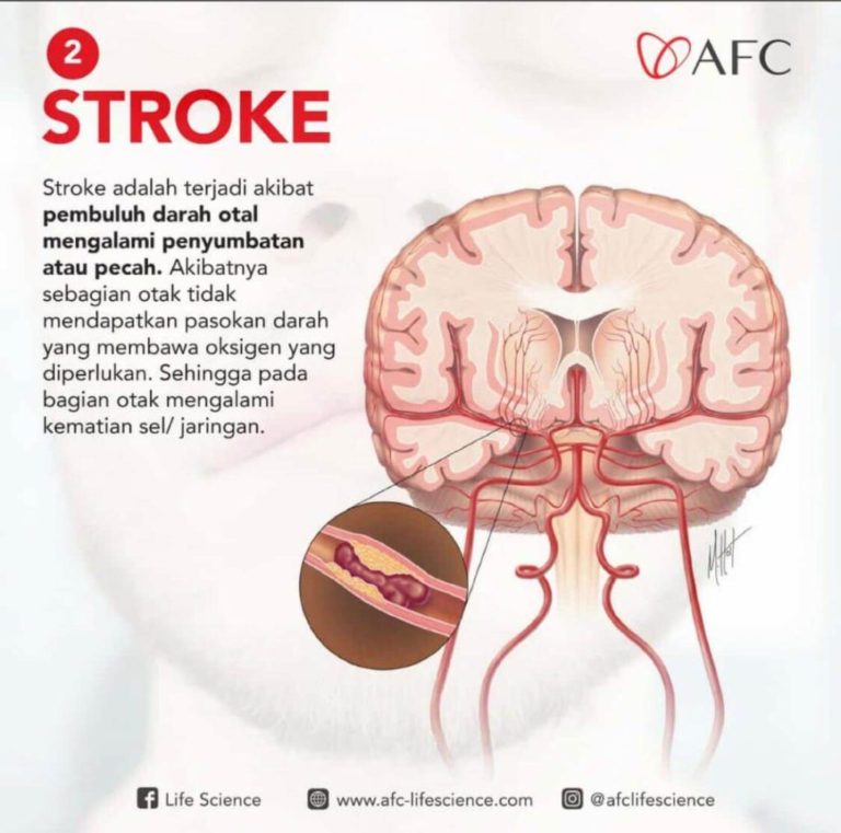 Stroke 2