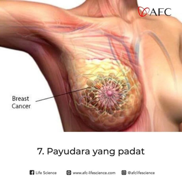 Faktor Resiko Kanker Payudara7