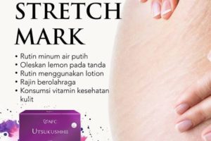 Stretch Mark