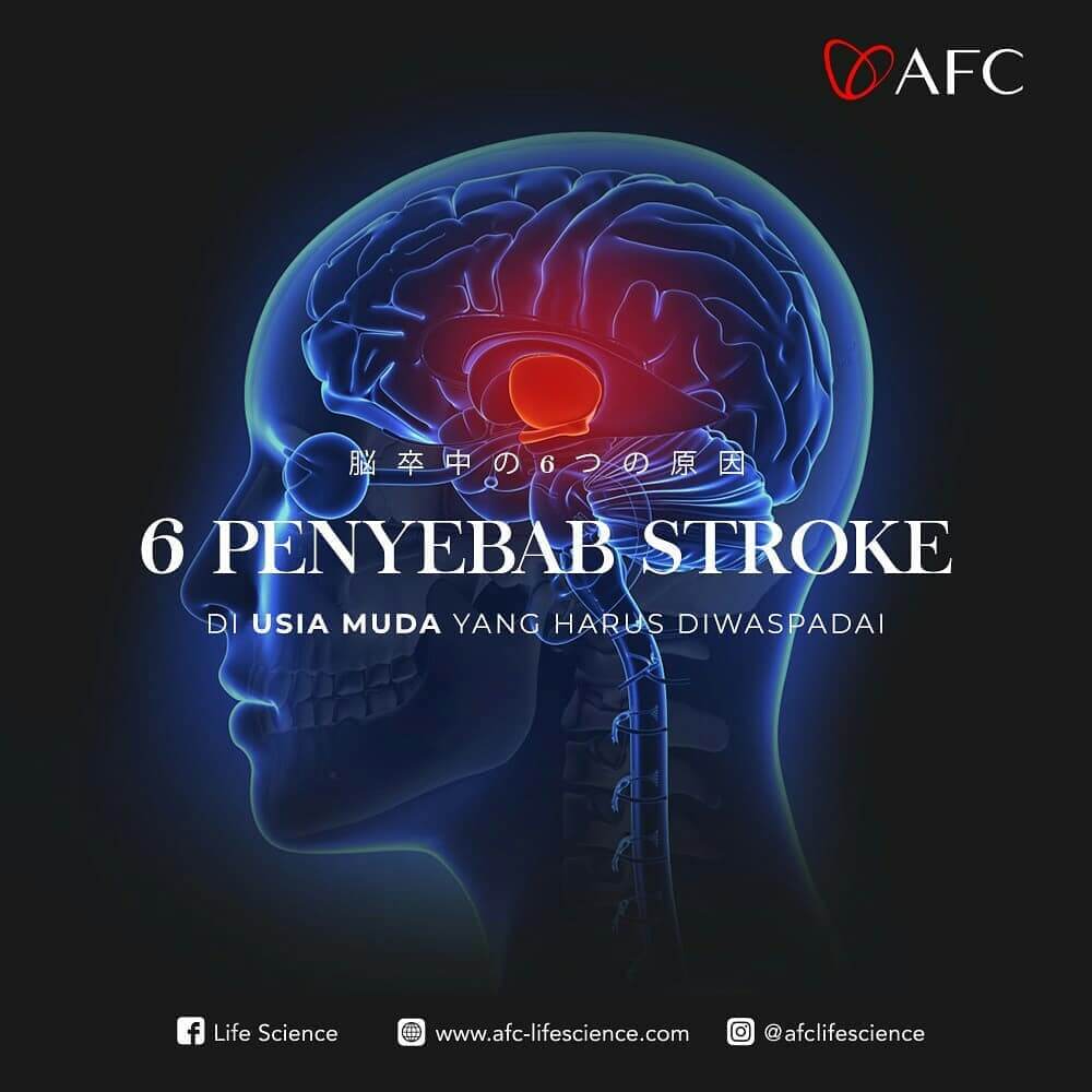 Penyebab Stroke Di Usia Muda Yang Perlu Diwaspadai