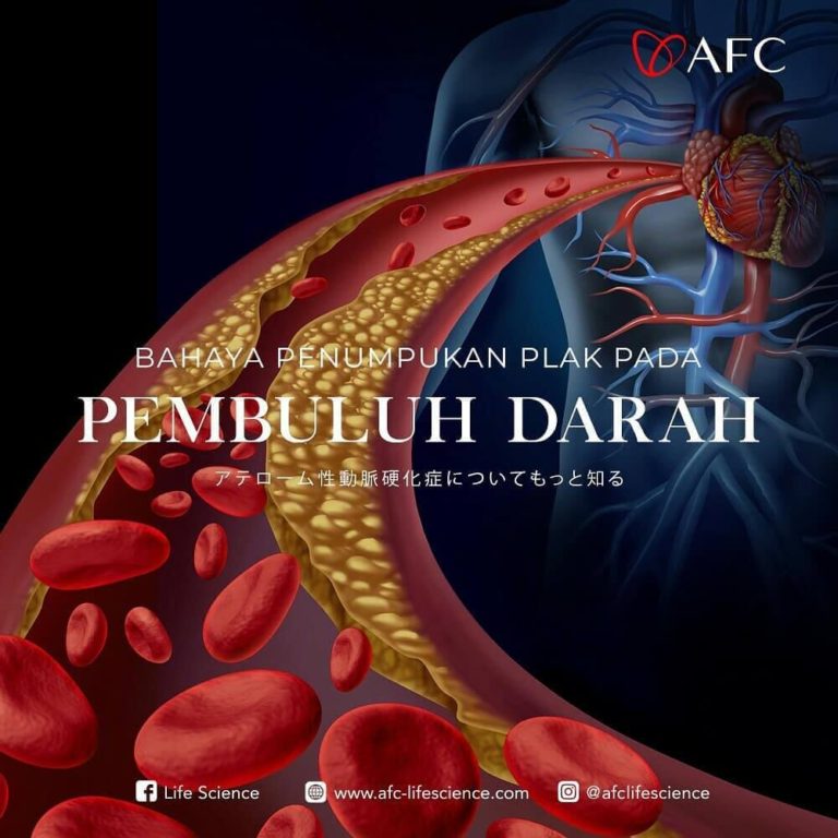 Penumpukan Plak Pada Pembuluh Darah0